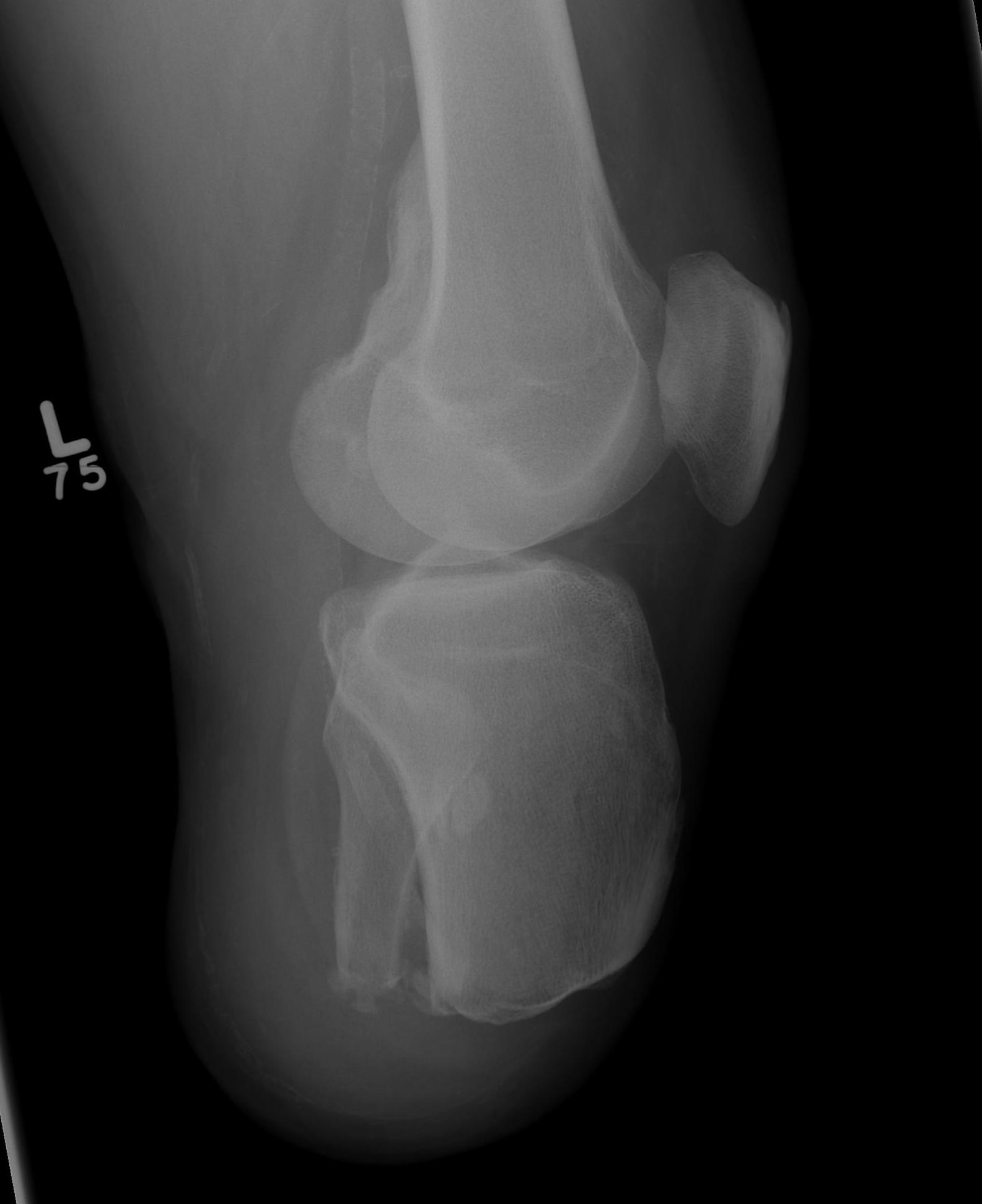 BKA Lateral Xray